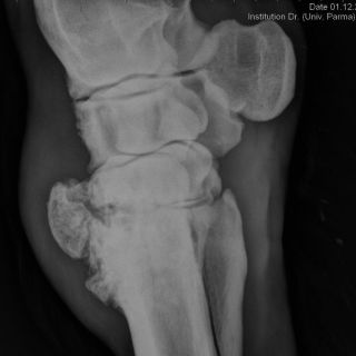 Hochgradige Arthrose am Karpus