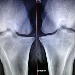 Zyste am medialen Condylus distal am Femur; zusätzlich eine kleine Zubildung an der Tibia (kleiner Pfeil); rechts das andere Gelenk