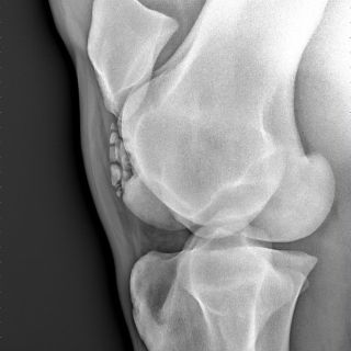 Hochgradige OCD (Osteochondrosis) am Knie