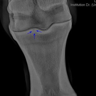 Ein kleiner zystoider Defekt proximal am Fesselbein