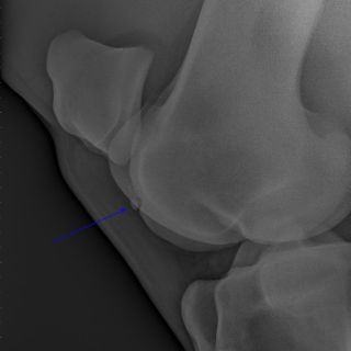 Eine isolierte Verschattung (Chip) am Knie: OCD